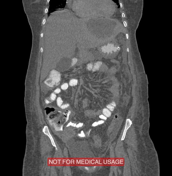 File:Amoebic enterocolitis with liver abscess (Radiopaedia 35100-36609 B 64).jpg