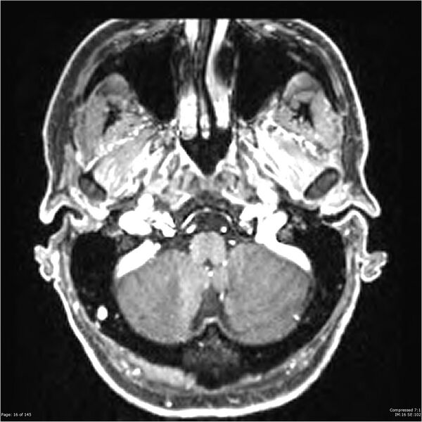 File:Anaplastic meningioma with recurrence (Radiopaedia 34452-35788 Axial T1 C+ 16).jpg
