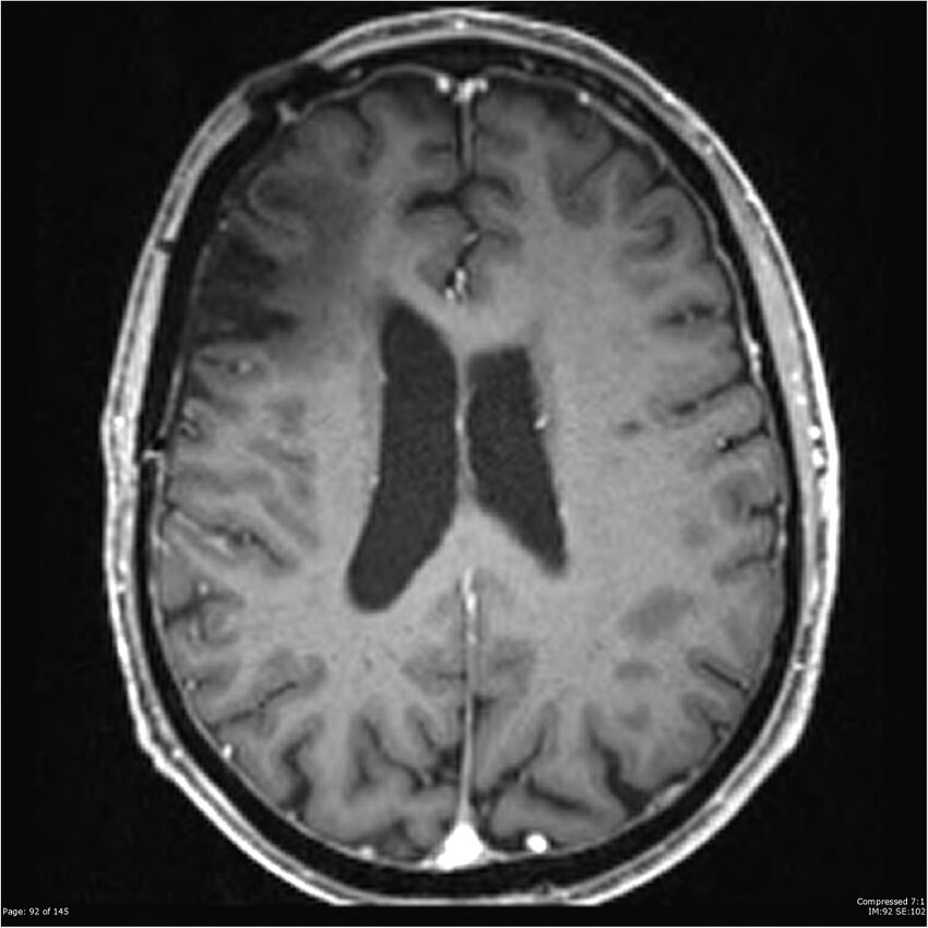 Anaplastic meningioma with recurrence (Radiopaedia 34452-35788 Axial T1 C+ 92).jpg
