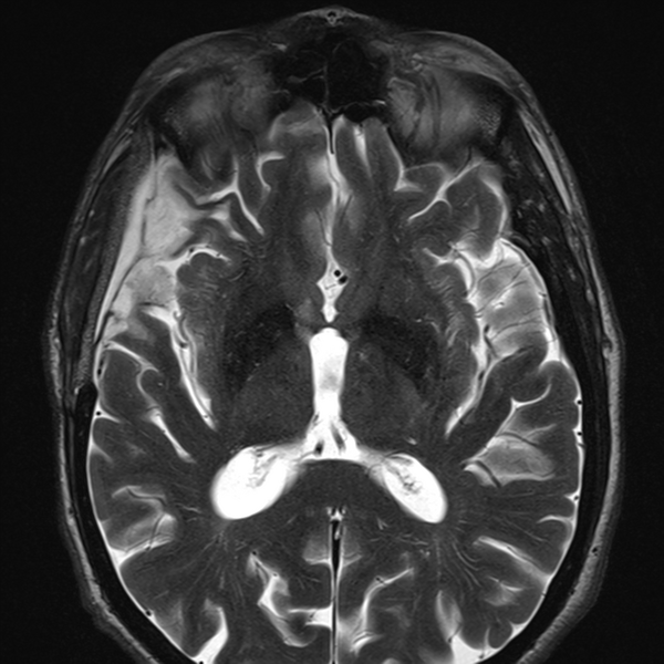 File:Anaplastic meningioma with recurrence (Radiopaedia 34452-35788 Axial T2 12).png