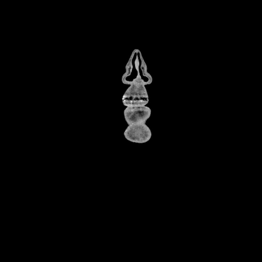 Anaplastic thyroid carcinoma (Radiopaedia 79087-92034 A 16).jpg