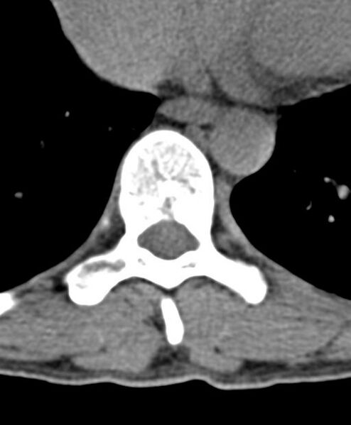 File:Aneurysmal bone cyst T11 (Radiopaedia 29294-29721 Axial non-contrast 23).jpg
