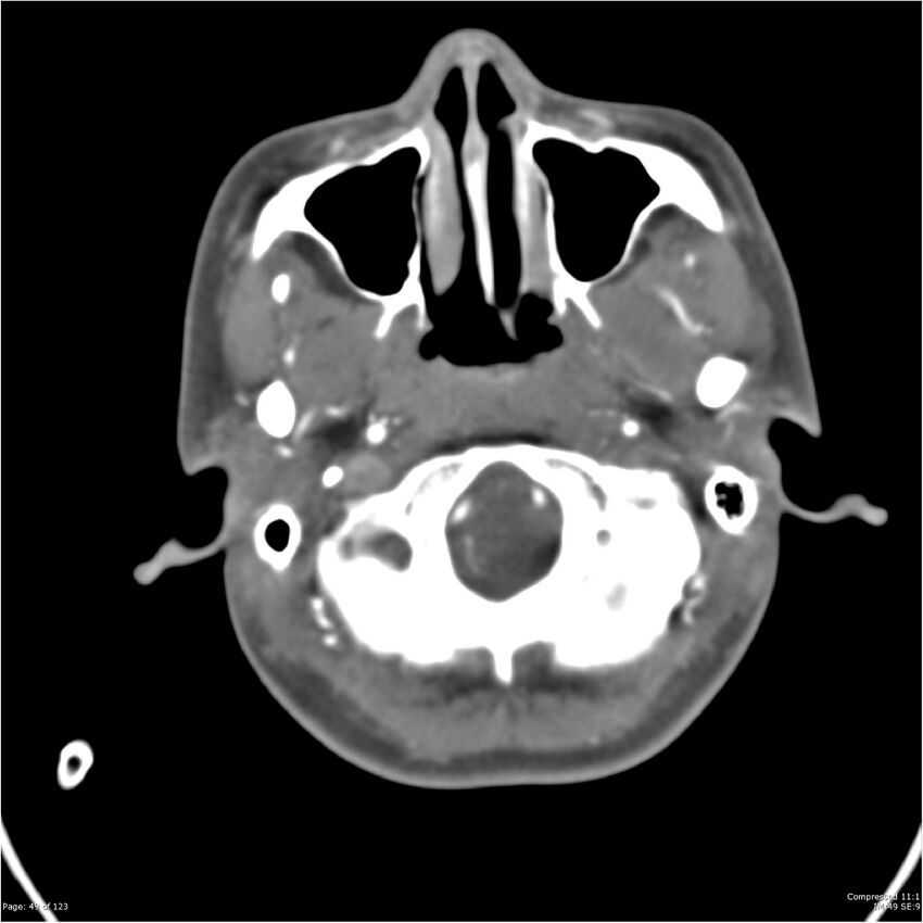 Aneurysmal subarachnoid hemorrhage and Moya Moya disease (Radiopaedia 34306-35593 Axial CT COW 49).jpg