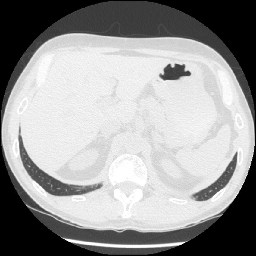 Angioinvasive aspergillosis (Radiopaedia 43957-47466 Axial lung window 67).jpg
