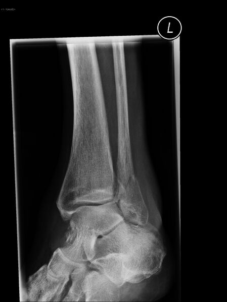 File:Ankle fracture - Weber B (Radiopaedia 16118).jpg