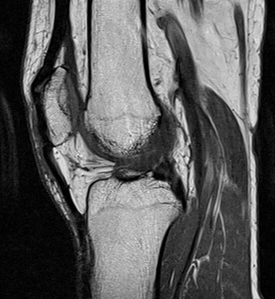 File:Anterior cruciate ligament avulsion injury (Radiopaedia 13134-13169 Sagittal T1 1).jpg