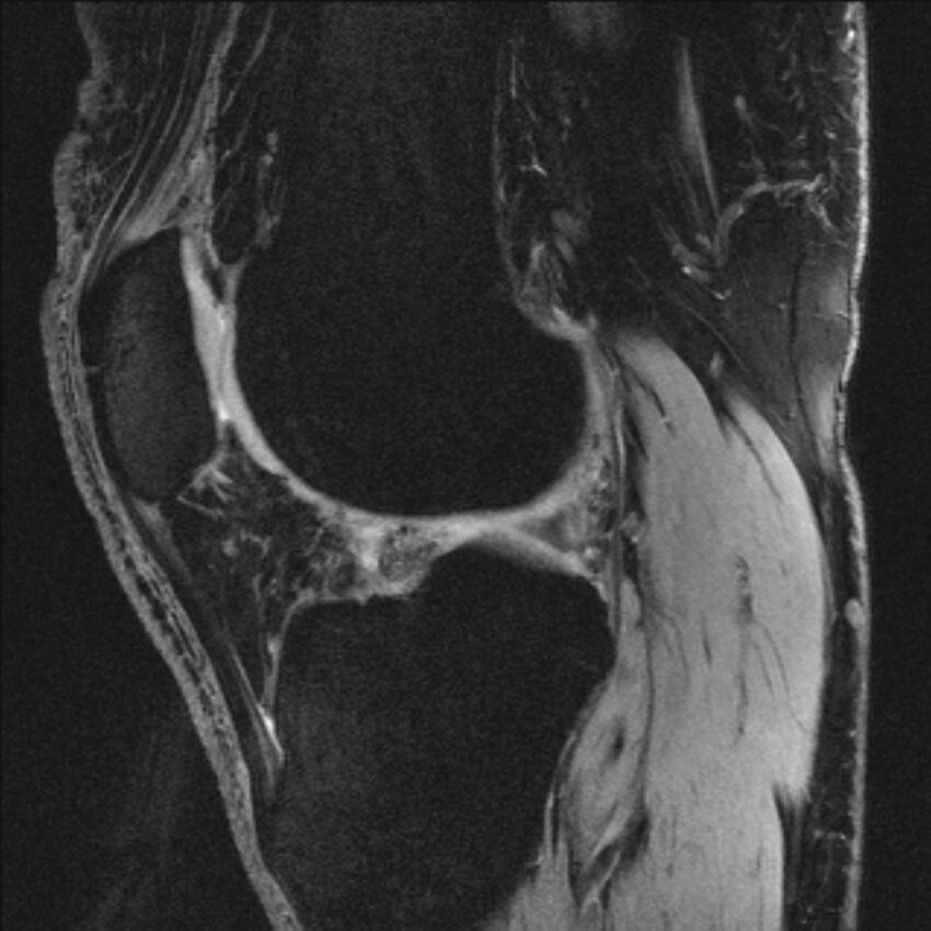 Anterior cruciate ligament mucoid degeneration (Radiopaedia 68400-77933 Sagittal 24).jpg