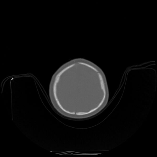 File:Anterior plagiocephaly (Radiopaedia 71836-82273 C 90).jpg