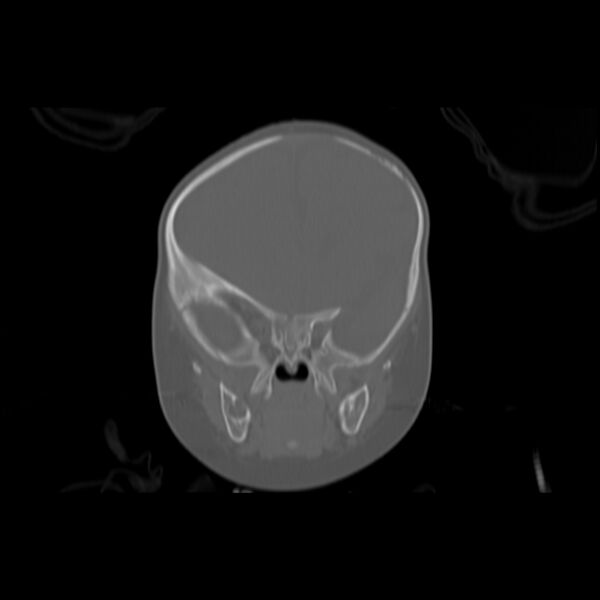 File:Anterior plagiocephaly (Radiopaedia 71836-82273 Coronal bone window 6).jpg