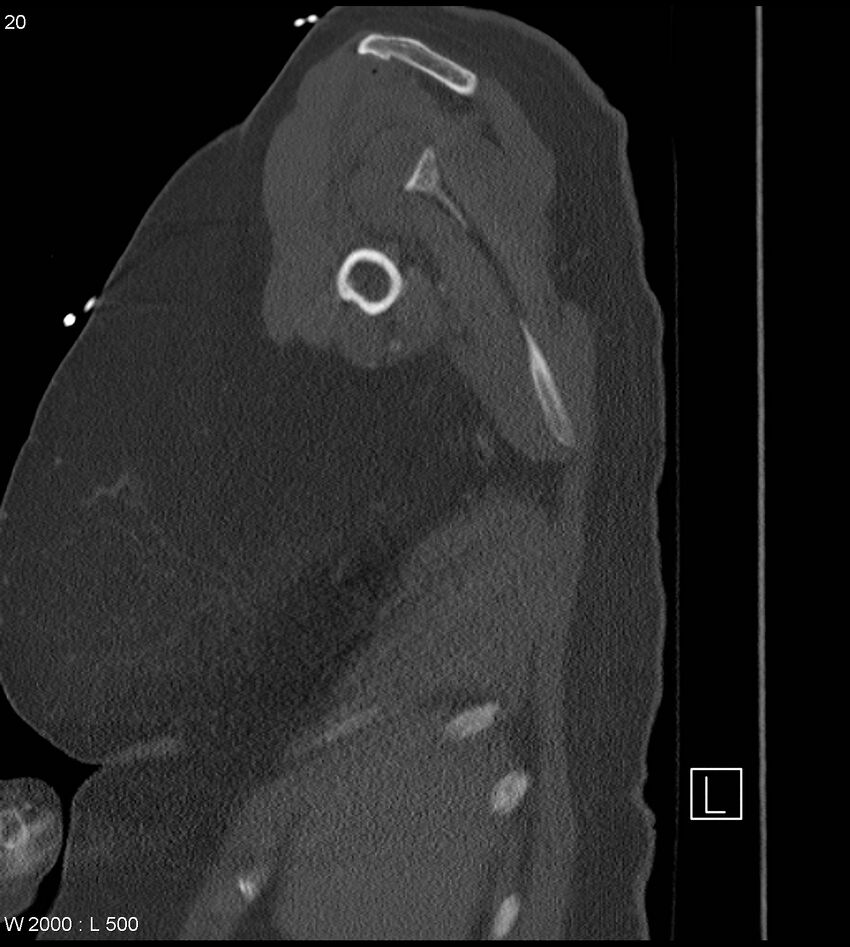 Anterior shoulder dislocation (CT) (Radiopaedia 59032-66309 Sagittal bone window 10).jpg