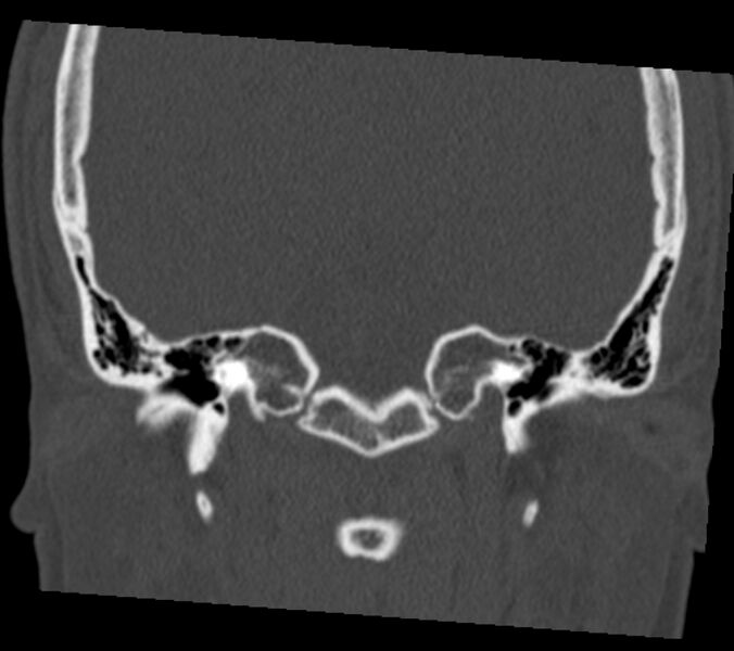 File:Antrochoanal polyp (Radiopaedia 21894-21868 Coronal bone window 39).jpg