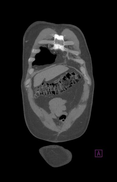 File:Aortectomy and axillary-bifemoral bypass (Radiopaedia 28303-28545 C 15).jpg
