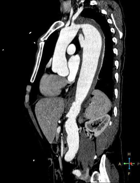 File:Aortic aneurysm and penetrating ulcer (Radiopaedia 23590-23704 C 13).jpg