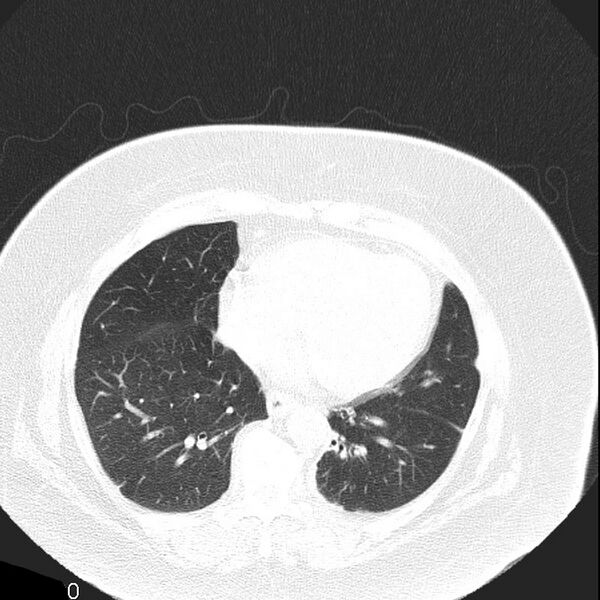 File:Aortic arch false aneurysm (Radiopaedia 14667-14587 Axial lung window 16).jpg