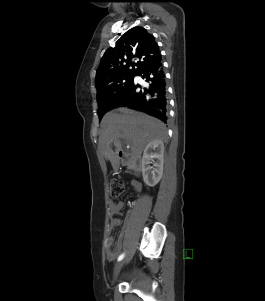 File:Aortic dissection with renal ischemia (Radiopaedia 76573-88338 D 4).jpg
