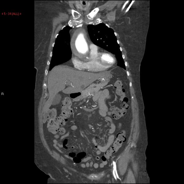 File:Aortic intramural hematoma (Radiopaedia 27746-28001 B 11).jpg