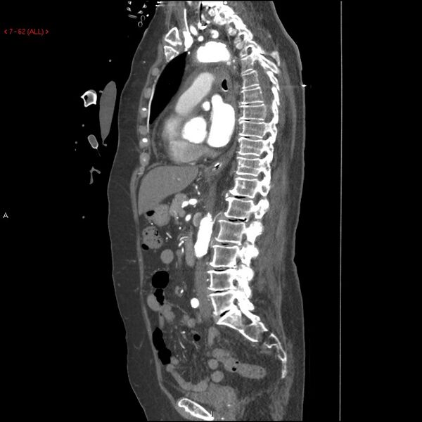 File:Aortic intramural hematoma (Radiopaedia 27746-28001 C 31).jpg