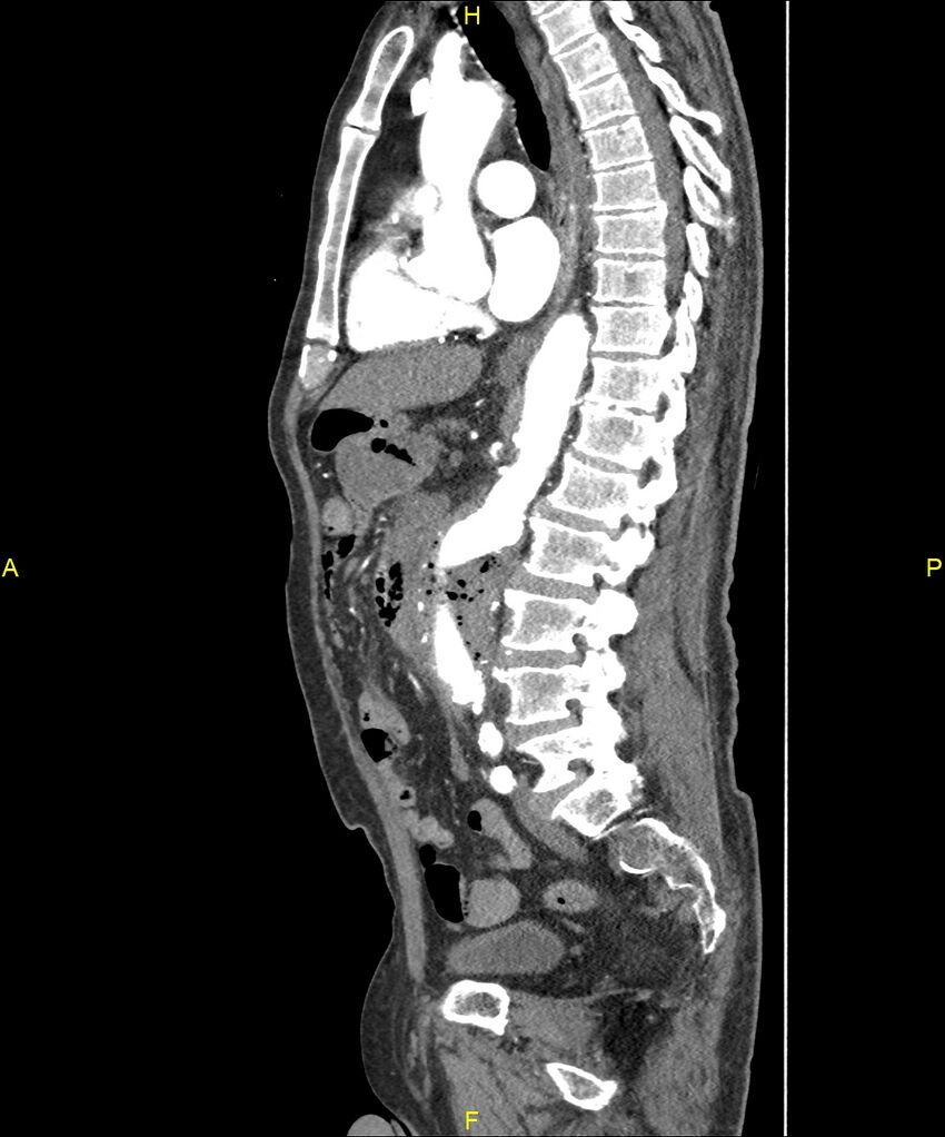 Aortoenteric fistula (Radiopaedia 84308-99603 C 190).jpg