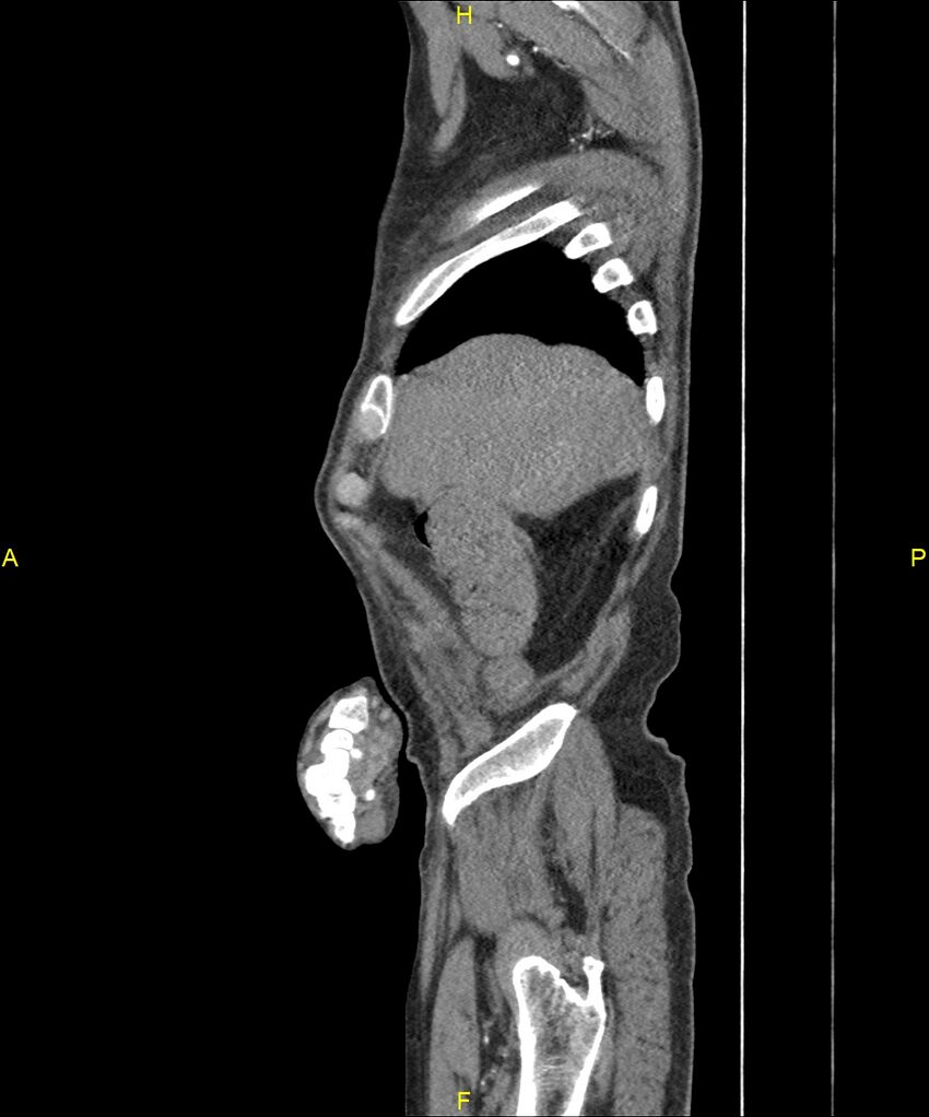 Aortoenteric fistula (Radiopaedia 84308-99603 C 44).jpg