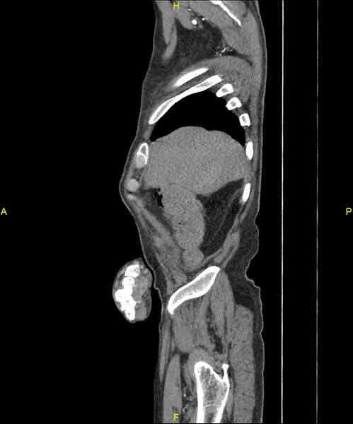 File:Aortoenteric fistula (Radiopaedia 84308-99603 C 45).jpg