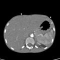 Aortopulmonary window, interrupted aortic arch and large PDA giving the descending aorta (Radiopaedia 35573-37074 B 93).jpg