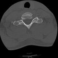 Apical pneumothorax on cervical spine CT (Radiopaedia 45343-49368 Axial bone window 73).jpg