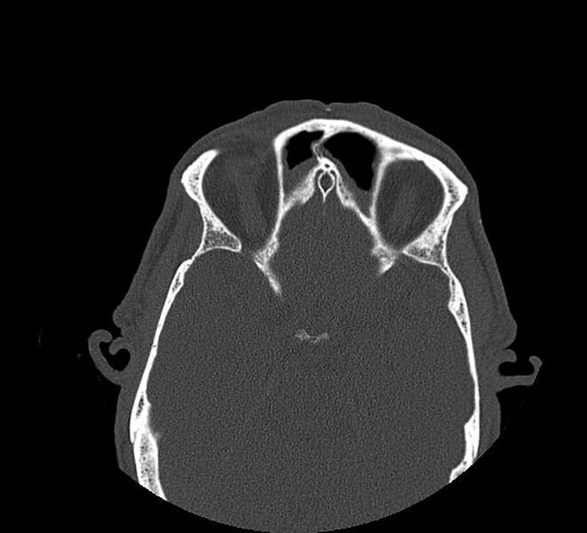 File:Aplastic maxillary sinuses (Radiopaedia 60030-67561 Axial non-contrast 55).jpg