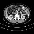 Appendicitis (Radiopaedia 14215-14073 A 65).jpg