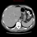 Appendicitis and renal cell carcinoma (Radiopaedia 17063-16760 A 10).jpg