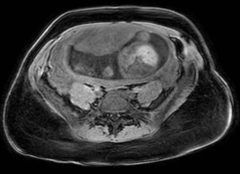 File:Appendicitis in gravida (MRI) (Radiopaedia 89433-106395 Axial DIXON 98).jpg