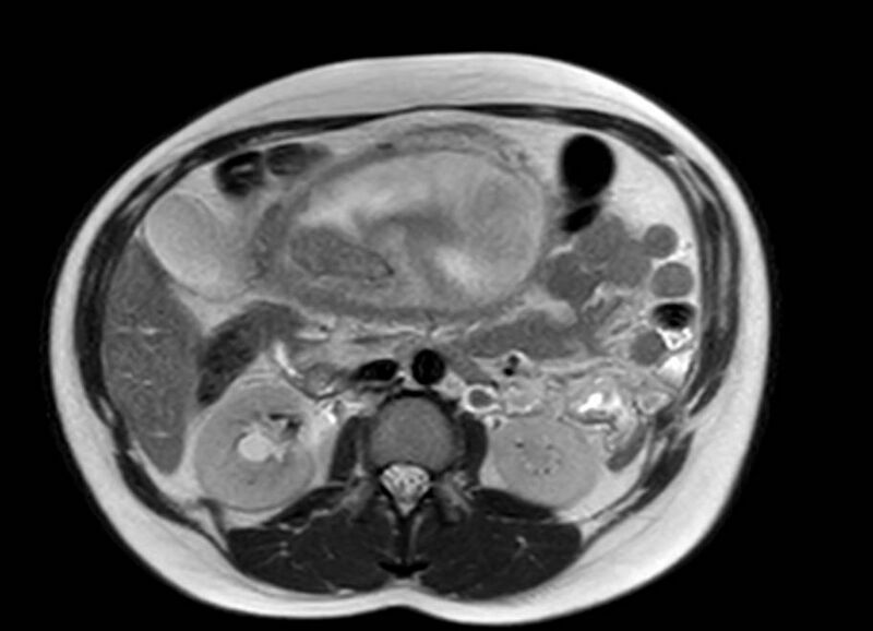 File:Appendicitis in gravida (MRI) (Radiopaedia 89433-106395 Axial T2 27).jpg