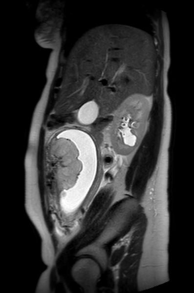 File:Appendicitis in gravida (MRI) (Radiopaedia 89433-106395 Sagittal T2 47).jpg