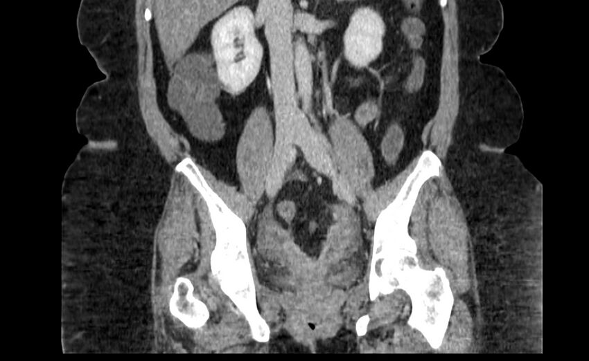 Appendix mucocele (Radiopaedia 41222-44033 B 51).jpg