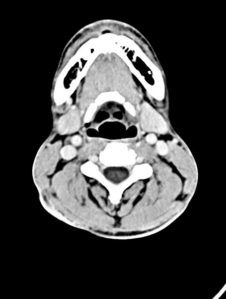 File:Arrow injury to the face (Radiopaedia 73267-84011 Axial C+ delayed 13).jpg