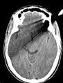 Arrow injury to the head (Radiopaedia 75266-86388 Axial non-contrast 21).jpg