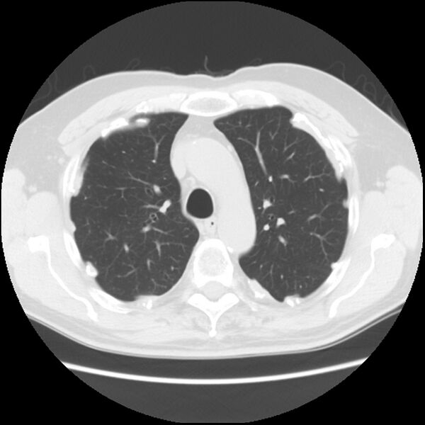 File:Asbestos-related pleural plaques (Radiopaedia 39069-41255 Axial lung window 22).jpg