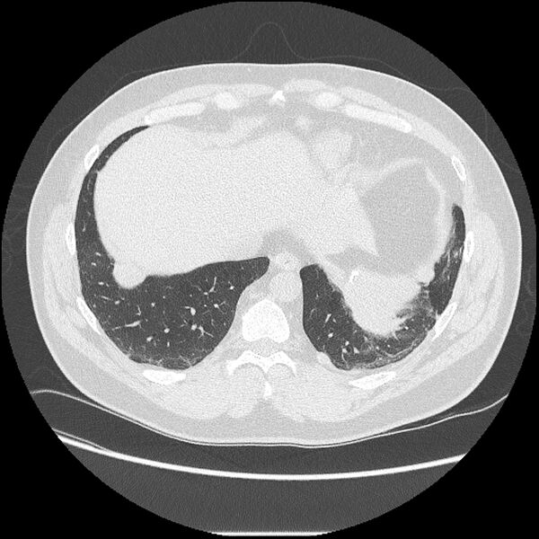 File:Asbestosis (Radiopaedia 45002-48961 Axial lung window 39).jpg