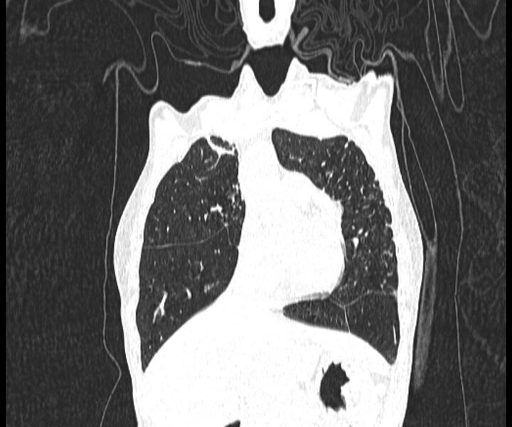 File:Aspergillomas (Radiopaedia 66779-76110 Coronal lung window 6).jpg