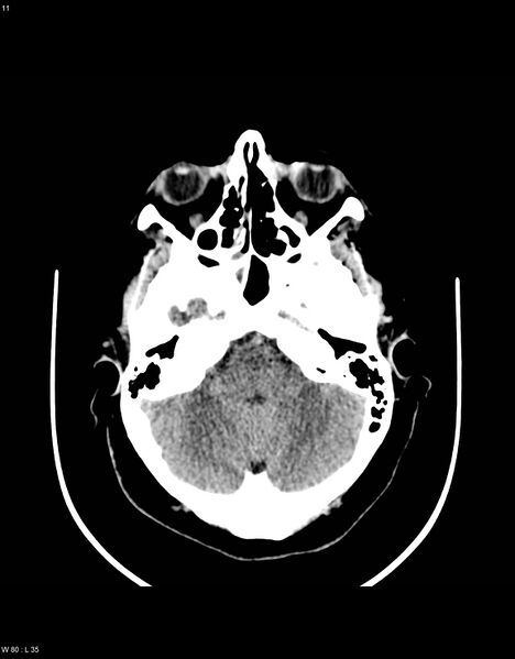 File:Astroblastoma (Radiopaedia 39792-42216 Axial non-contrast 10).jpg