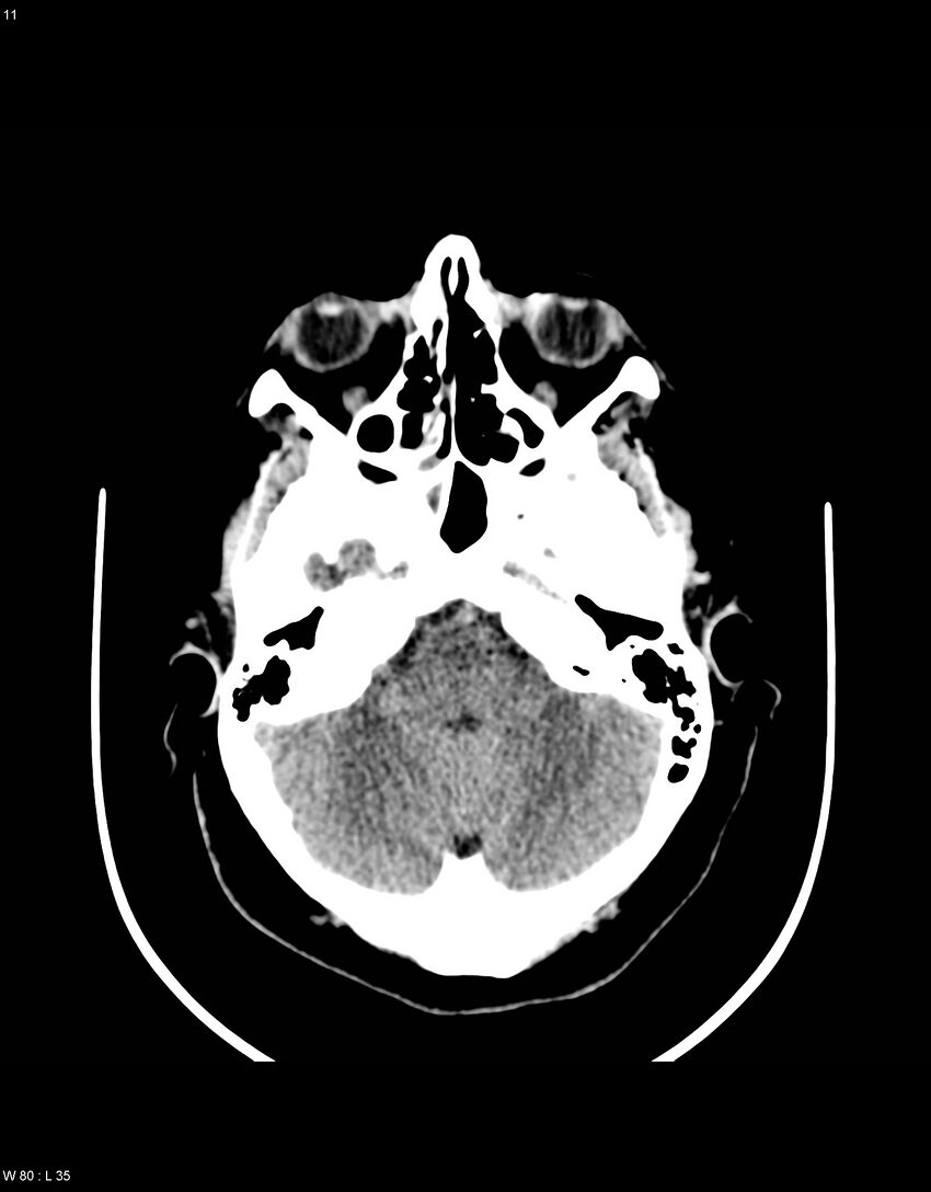 Astroblastoma (Radiopaedia 39792-42216 Axial non-contrast 10).jpg