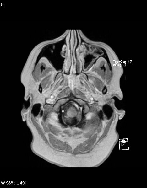 File:Astroblastoma (Radiopaedia 39792-42217 Axial T1 C+ 4).jpg