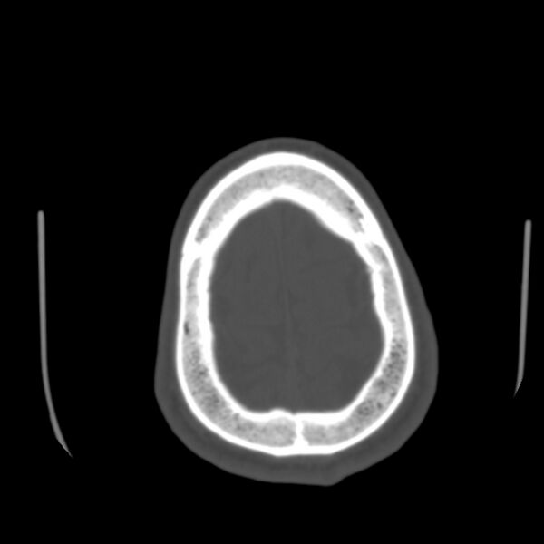 File:Asymptomatic occipital spur (Radiopaedia 87753-104201 Axial bone window 190).jpg