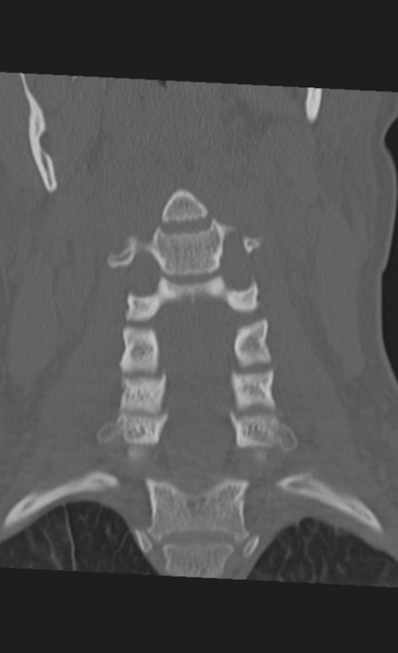 File:Atlanto-occipital dissociation (Radiopaedia 33848-35013 Coronal bone window 18).png