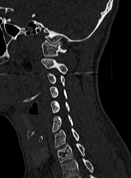 File:Atlantoaxial subluxation (Radiopaedia 44681-48450 Sagittal bone window 115).jpg