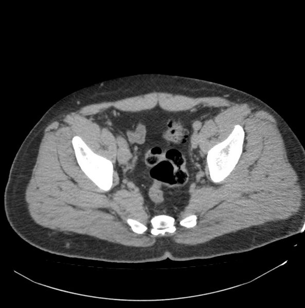 File:Atrophic kidney due to severe chronic obstructive hydronephrosis (Radiopaedia 40828-43474 Axial non-contrast 40).jpg