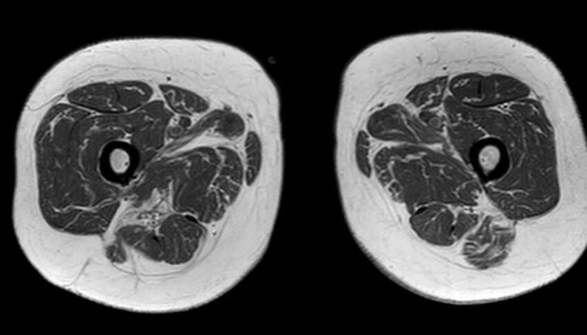 Atypical lipomatous tumor - thigh (Radiopaedia 68975-78734 Axial T1 64).jpg