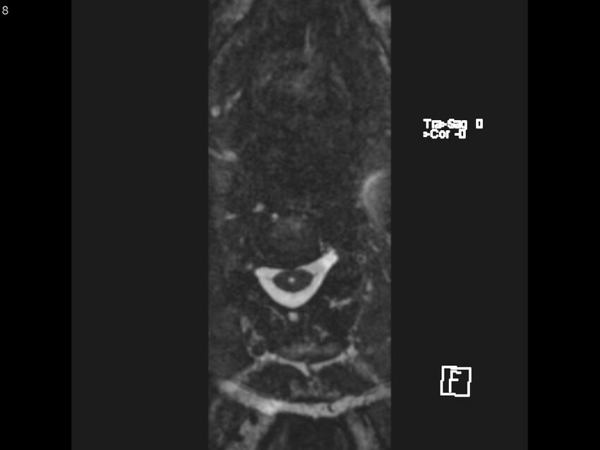 Atypical meningioma - intraosseous (Radiopaedia 64915-74572 Axial CISS 8).jpg