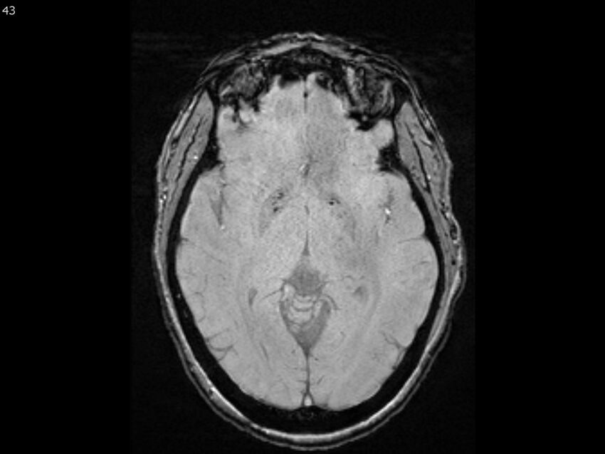 Atypical meningioma - intraosseous (Radiopaedia 64915-74572 Axial SWI 43).jpg