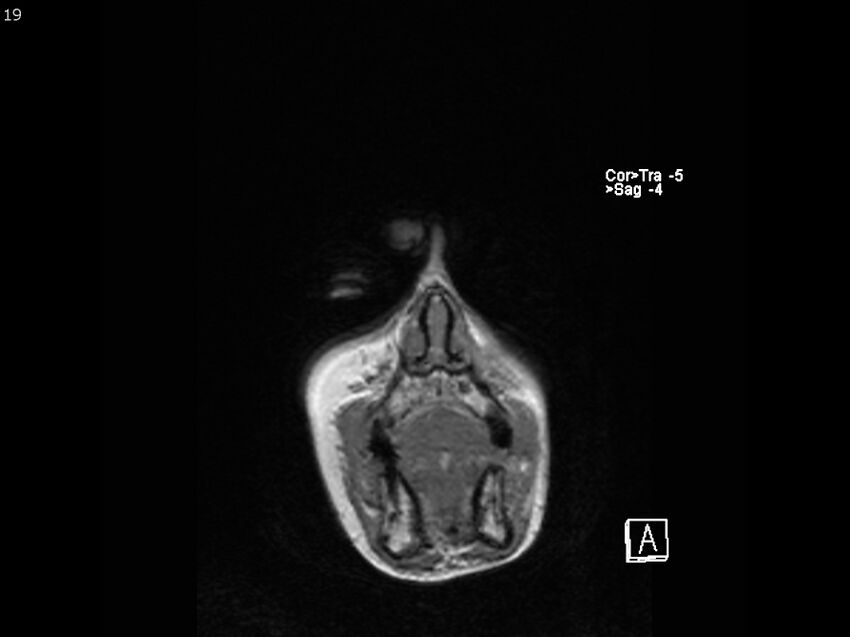 Atypical meningioma - intraosseous (Radiopaedia 64915-74572 Coronal T1 19).jpg