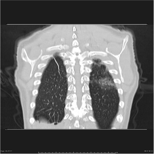 File:Atypical pneumonia - Q fever (Radiopaedia 21993-21989 C 39).jpg